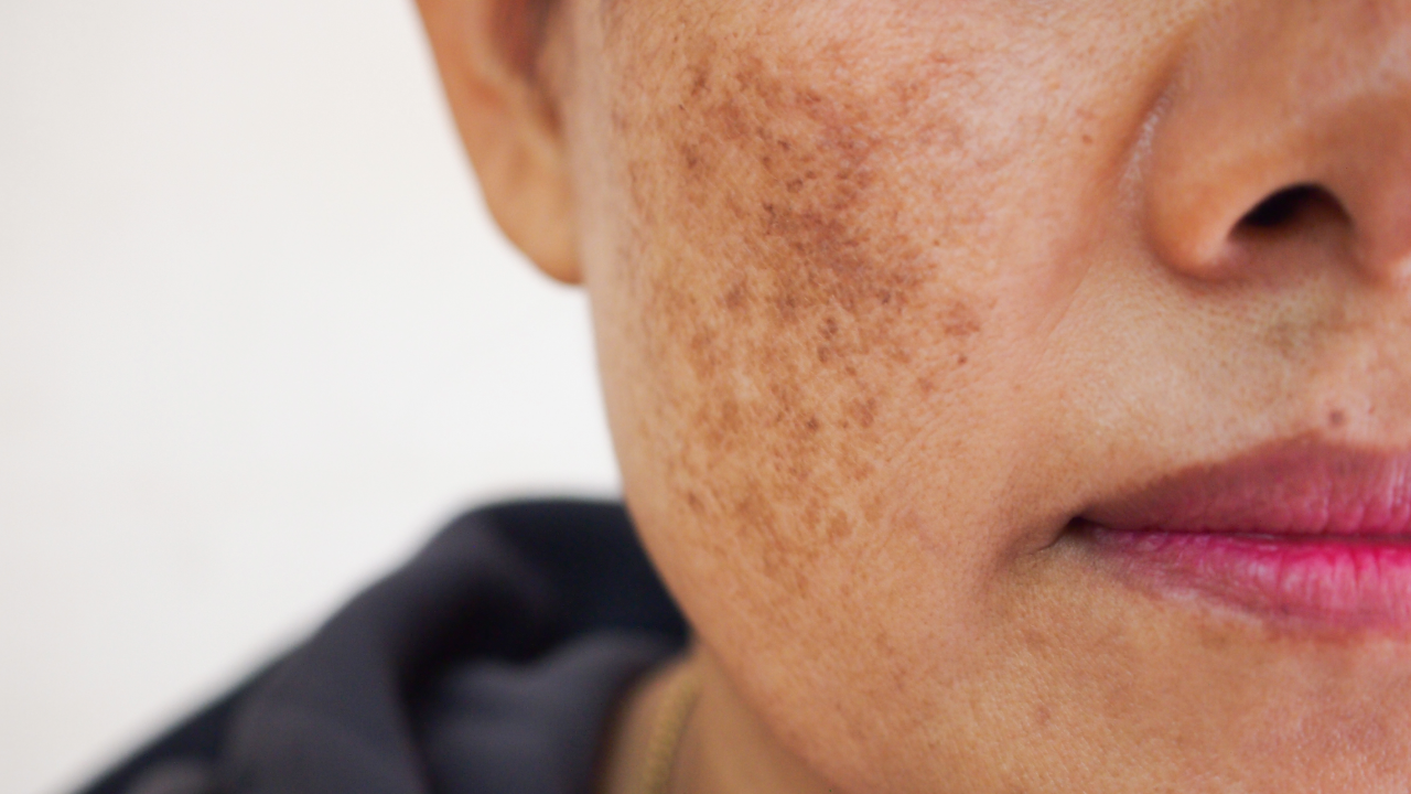 Understanding Melasma and Chloasma: Causes, Triggers, and Treatment